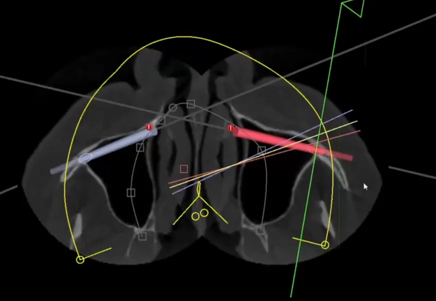 Corte axial da tomografia com as trajetórias dos implantes zigomáticos planejadas